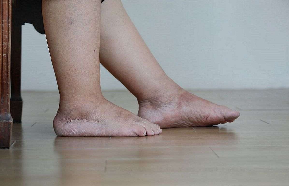 ورم پا - درمان ورم پا با پیاز