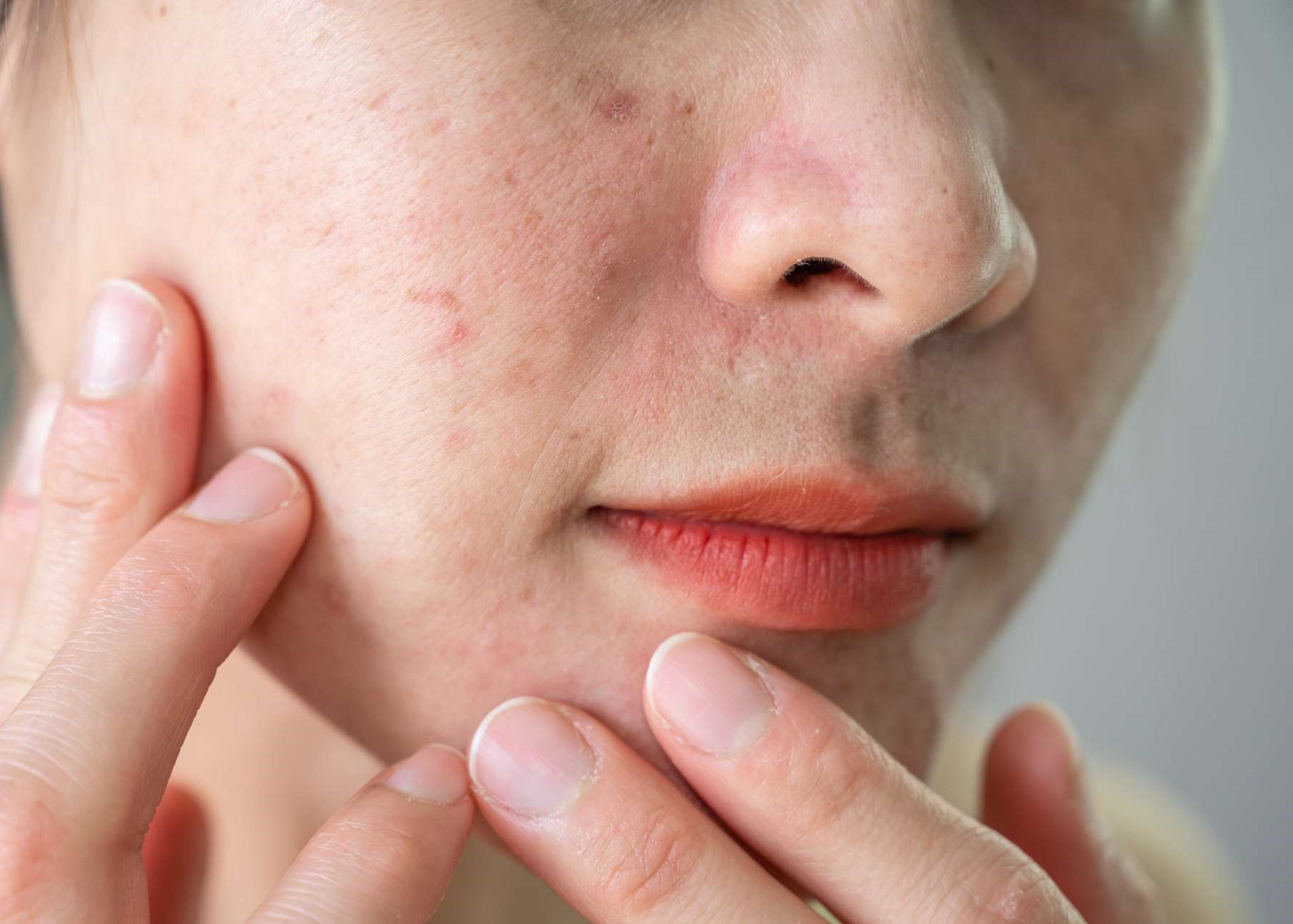 از بین بردن جوش صورت - چاق شدن صورت در یک هفته