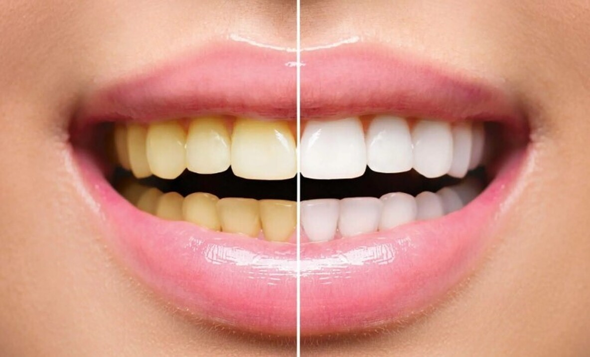  رفع زردی دندان - سفید کردن دندان با جوش شیرین