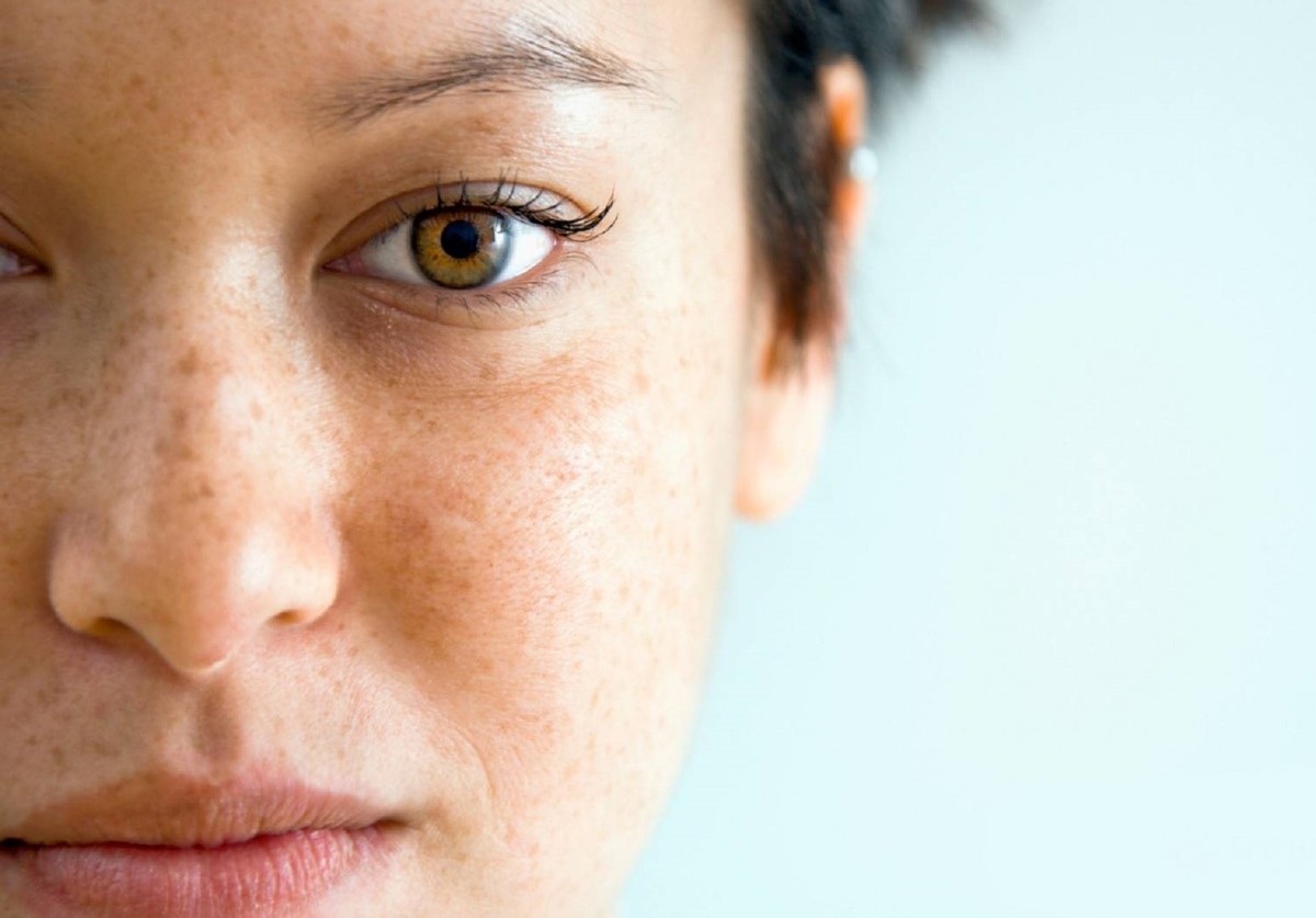 لکه ی پوستی - سفيد كردن پوست آفتاب سوخته