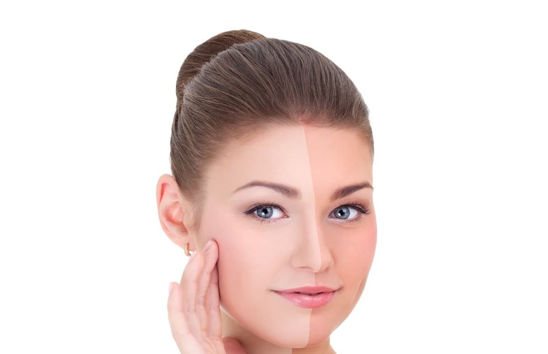 آفتاب سوختگی - سفيد كردن پوست آفتاب سوخته