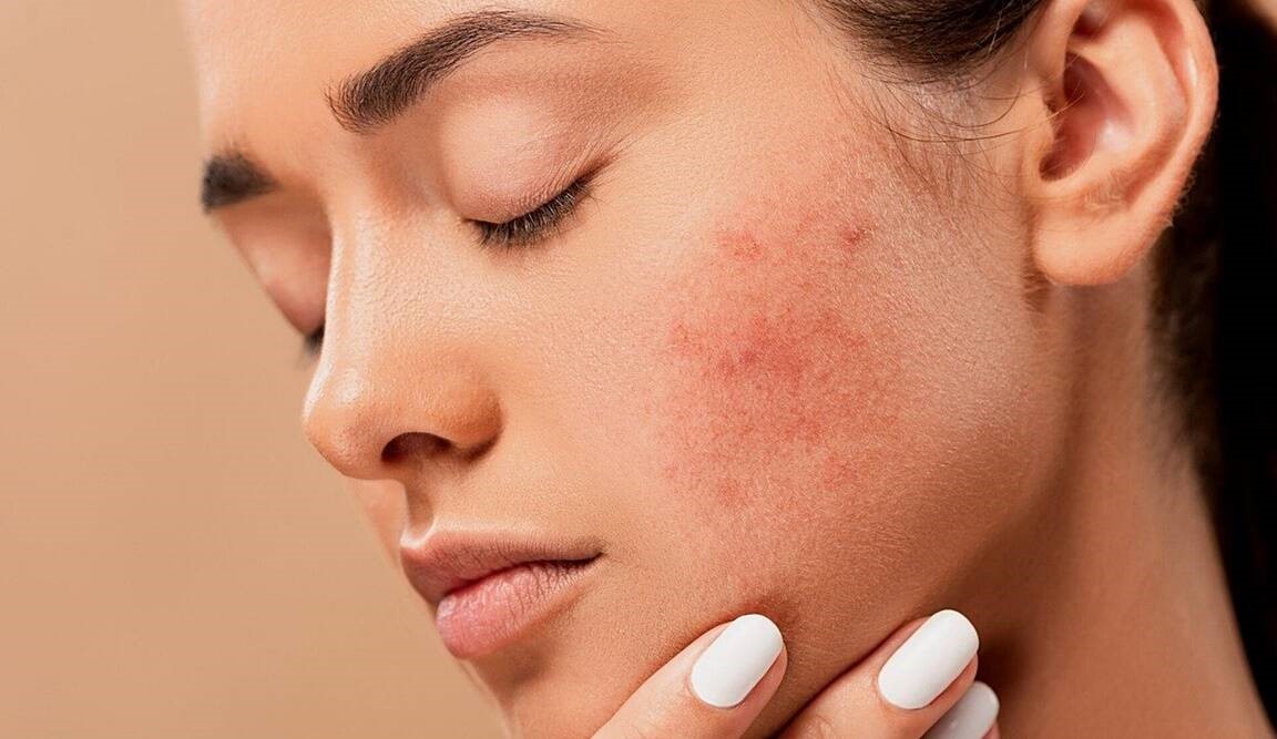 ماسک ضد لک صورت - لک صورت