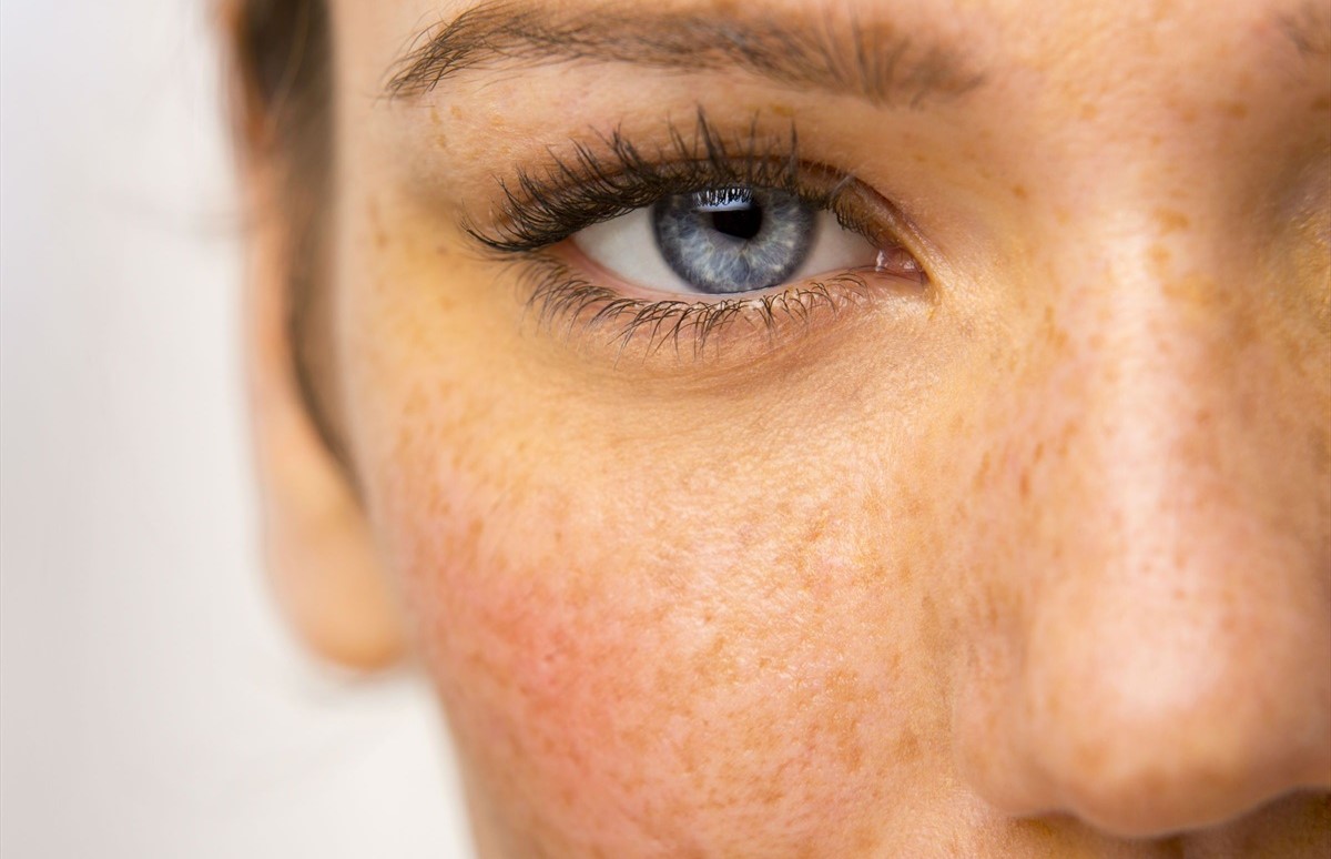 رفع لک پوستی - لک صورت