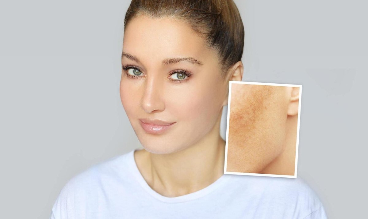 درمان لک صورت