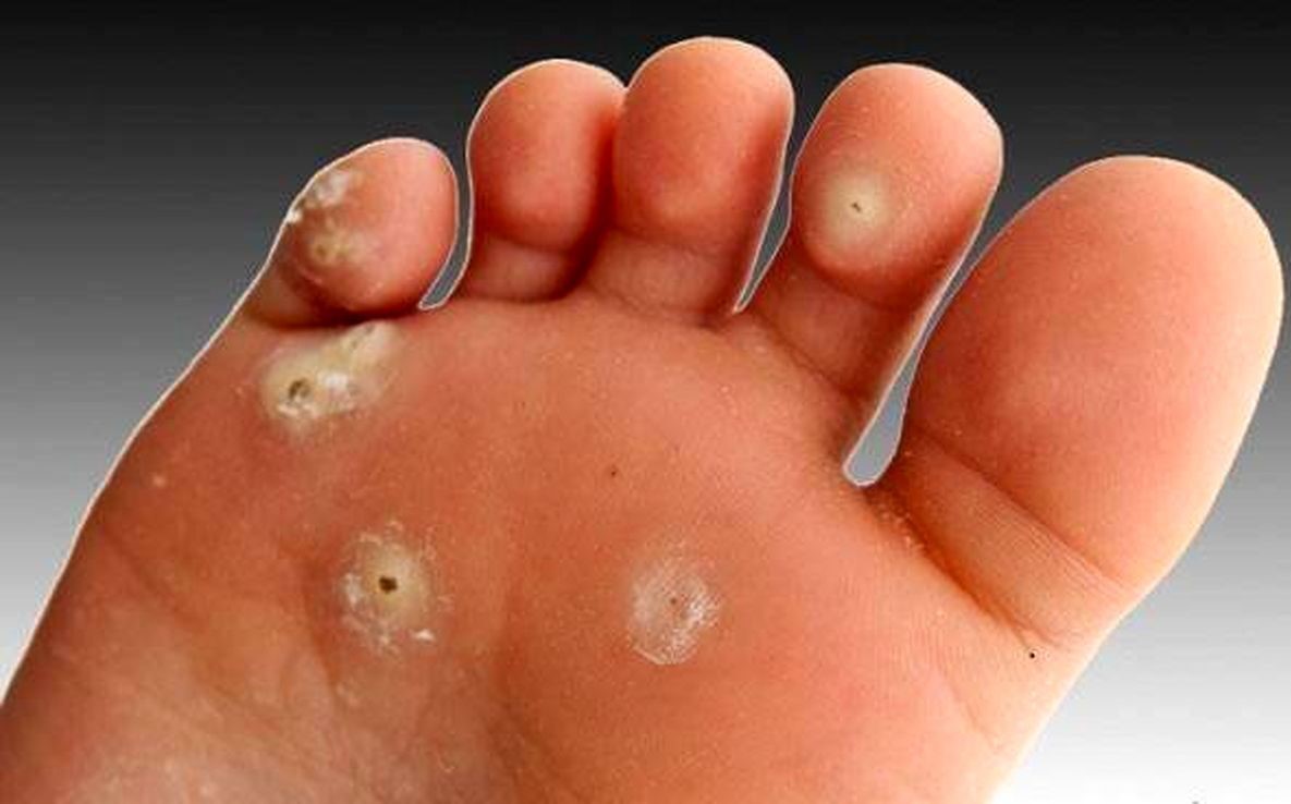 درمان خانگی میخچه - درمان خانگی میخچه کف پا