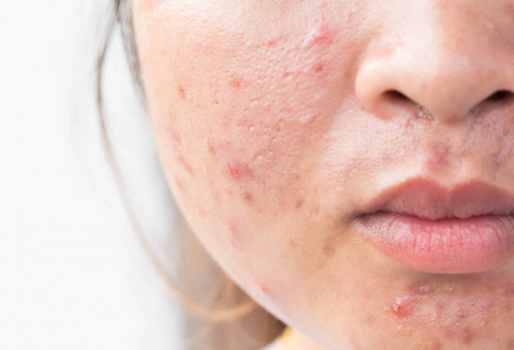 مراقبت بعد از وکس صورت - درمان سوختگی پوست صورت با وکس