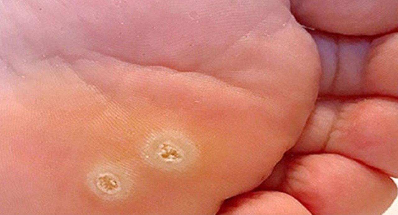 علت ایجاد میخچه - درمان خانگی میخچه کف پا