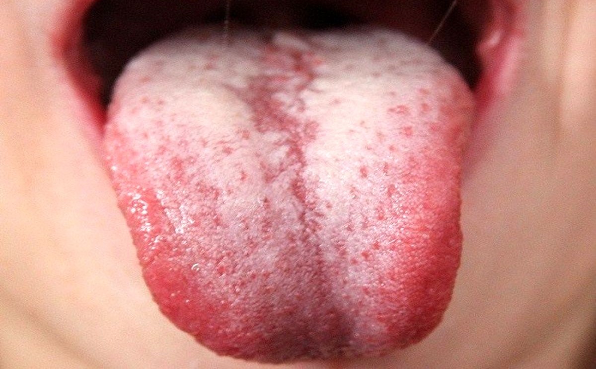 رنگ بنفش زبان - تشخیص بیماری از رنگ زبان