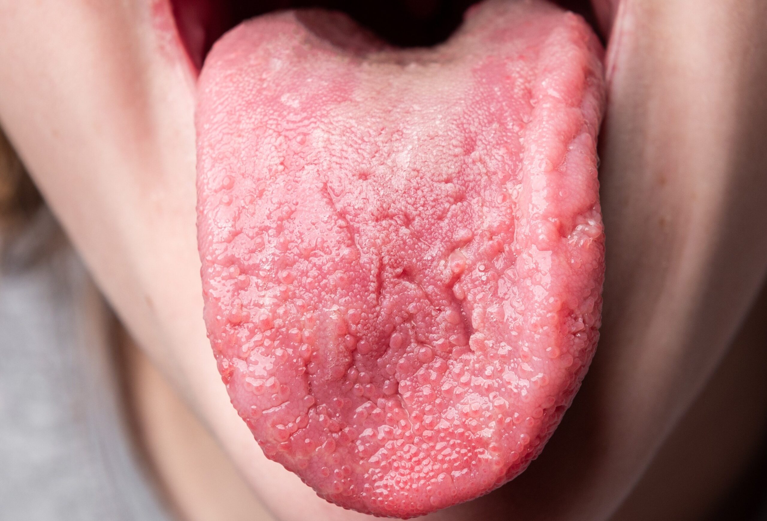 بیماری های زبان - تشخیص بیماری از رنگ زبان