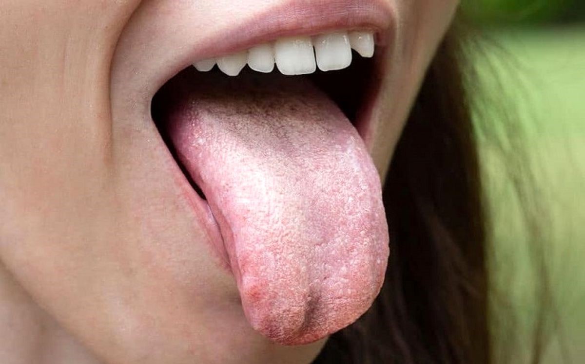 زردی زبان - تشخیص بیماری از رنگ زبان