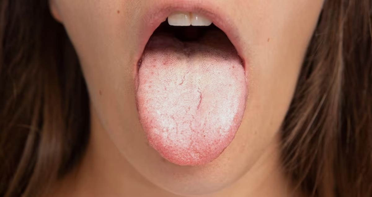 سفید شدن زبان - تشخیص بیماری از رنگ زبان