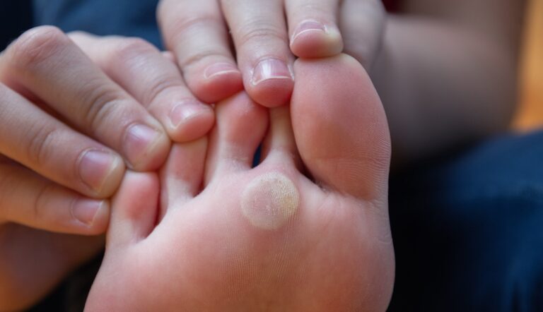 درمان خانگی میخچه کف پا