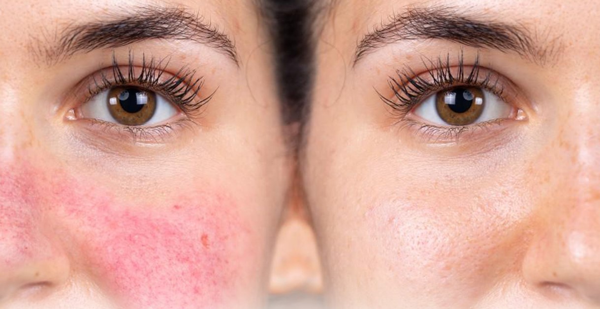 التهاب پوست بعد از وکس - درمان سوختگی پوست صورت با وکس