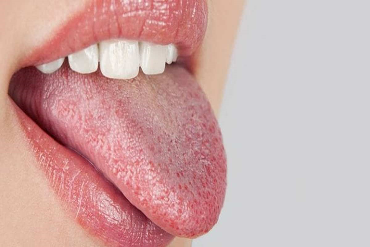 زبان سالم - تشخیص بیماری از رنگ زبان