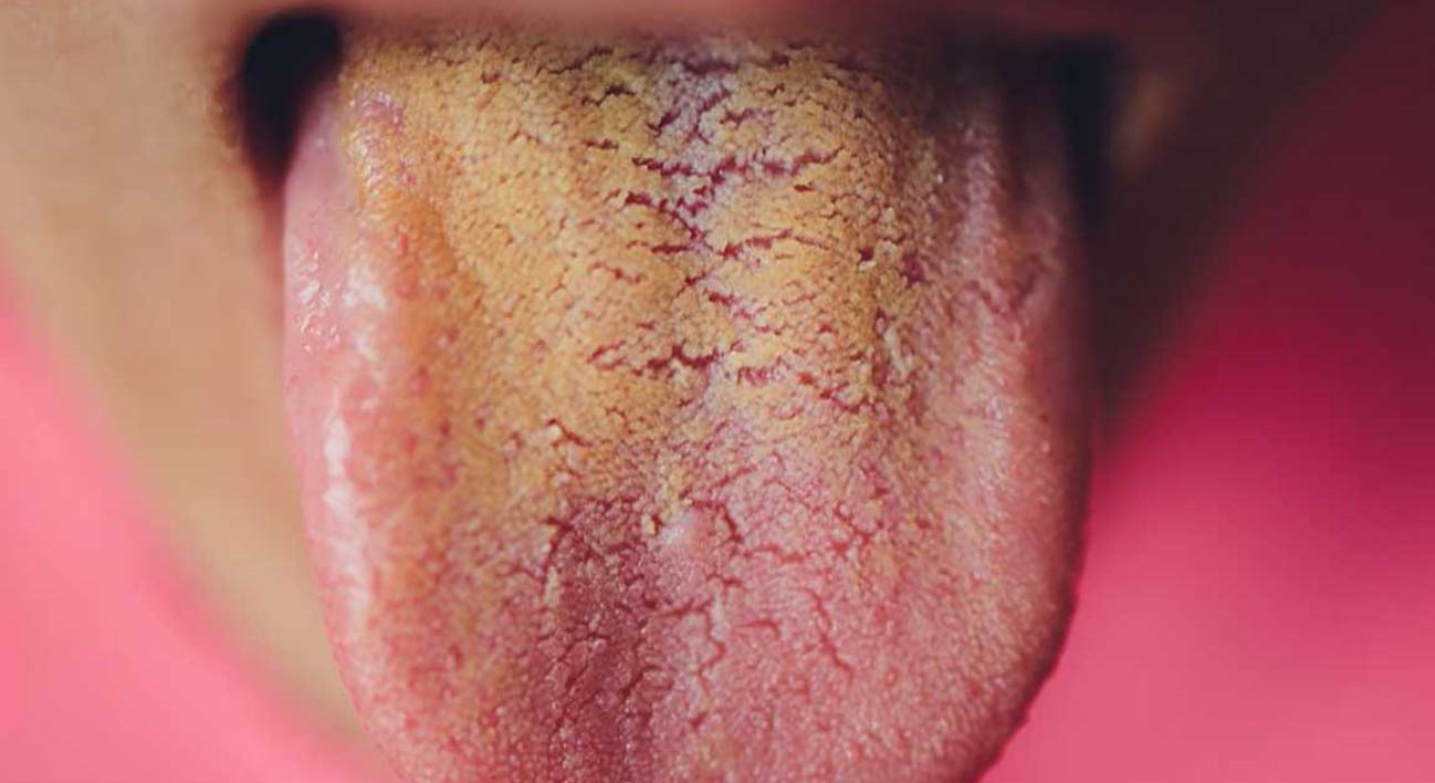 ترک خوردن زبان - تشخیص بیماری از رنگ زبان