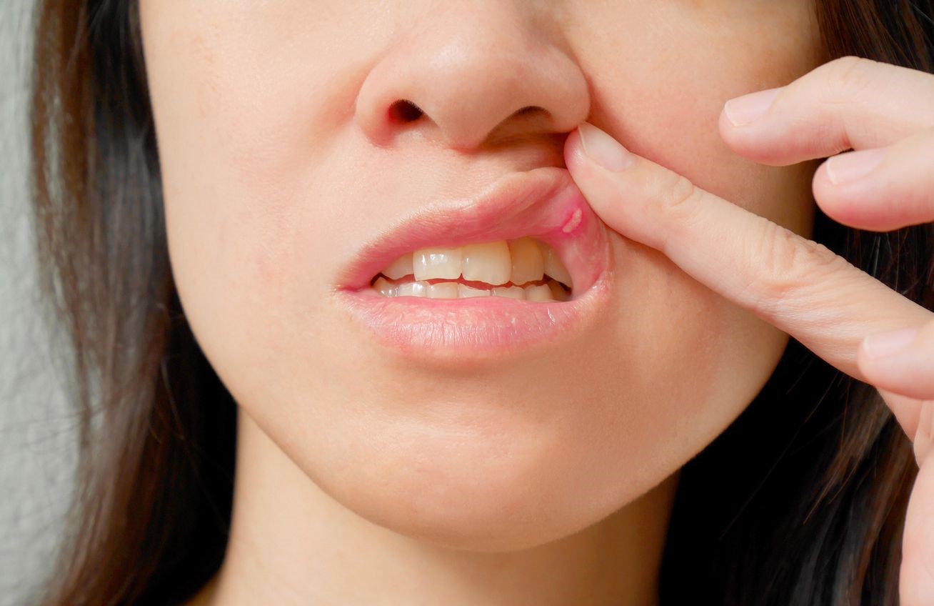 درمان آفت دهان با جوش شیرین - درمان آفت دهان با رب انار