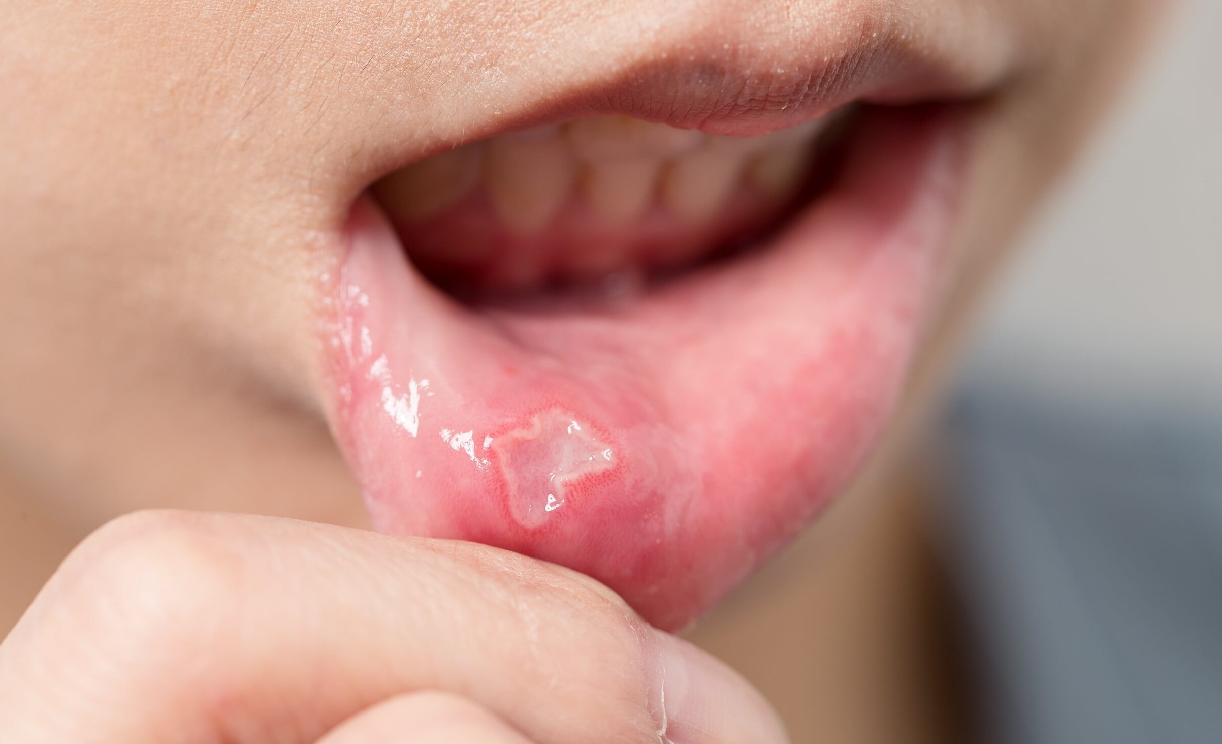 آفت دهان - درمان آفت دهان با رب انار