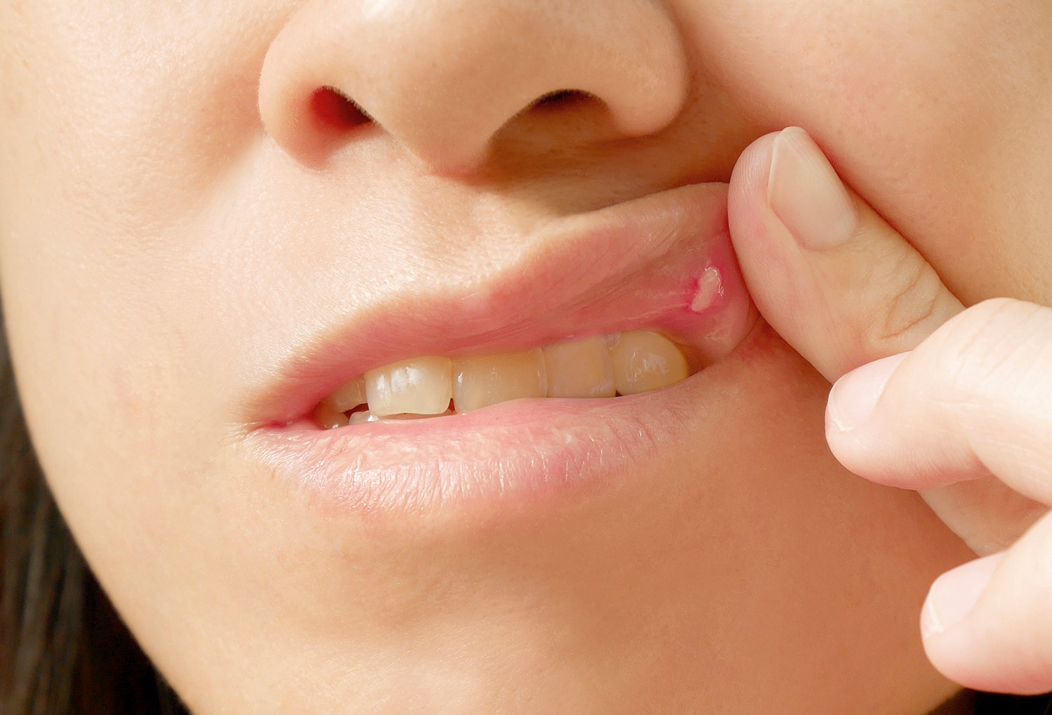 علت آفت دهان - درمان آفت دهان با رب انار