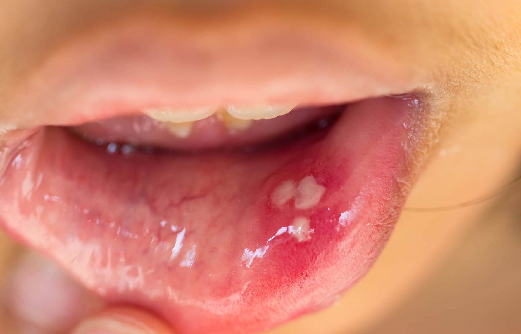 درمان خانگی آفت دهان - درمان آفت دهان با رب انار