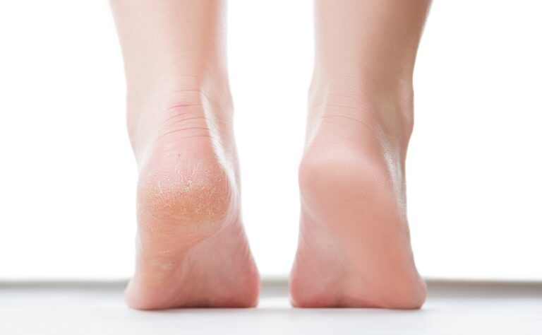 درمان ترک پا با جوش شیرین