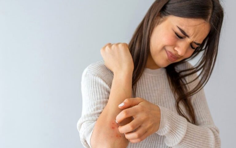 درمان خارش نیش پشه