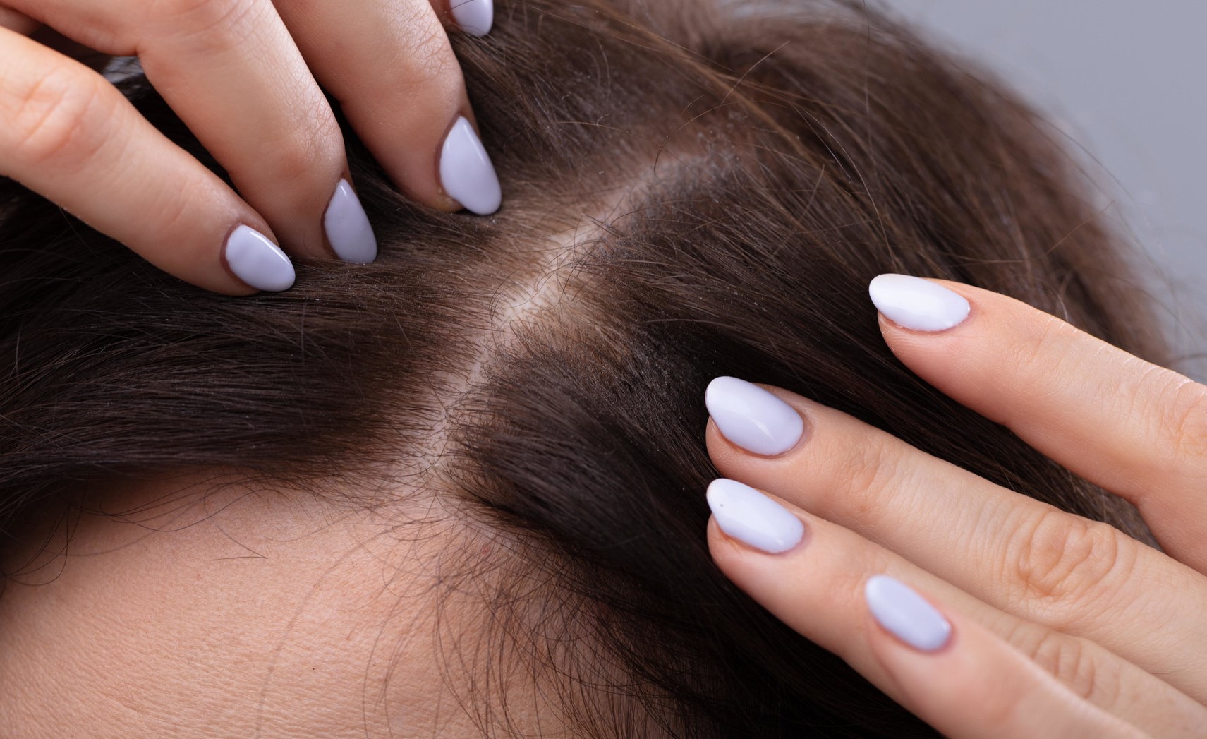 نازک شدن مو در زنان - ریزش مو ناشی از سندرم تخمدان