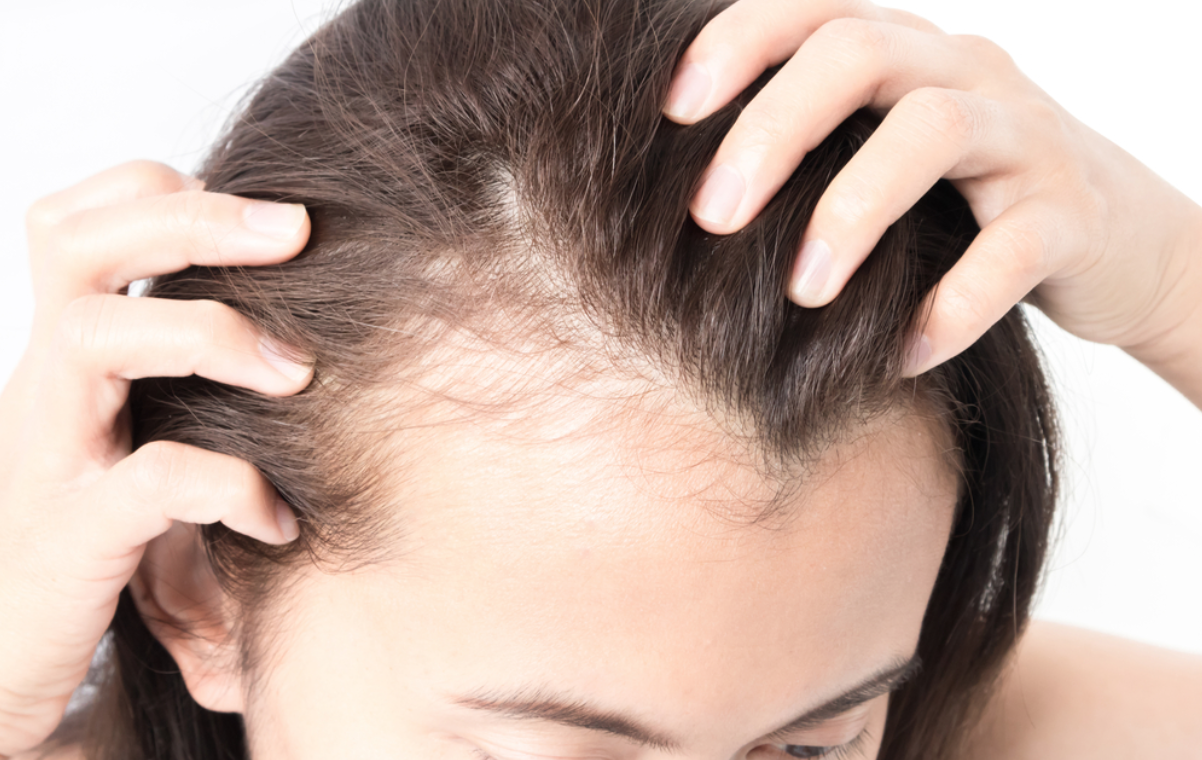 درمان ریزش مو ناشی از سندرم تخمدان