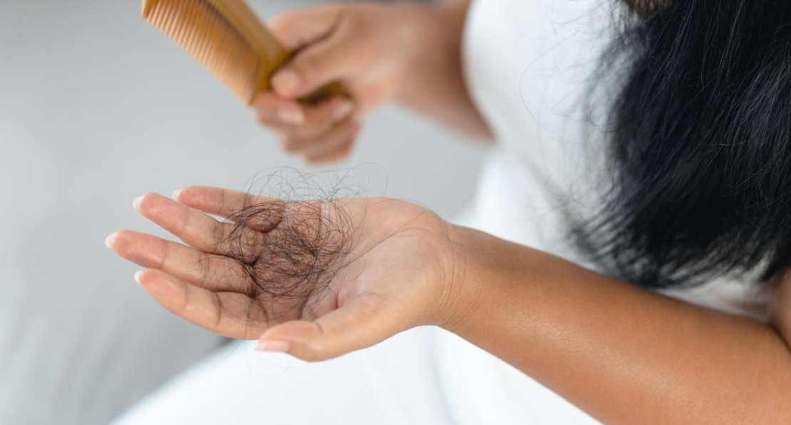 ریزش موی شدید - ریزش مو ناشی از سندرم تخمدان