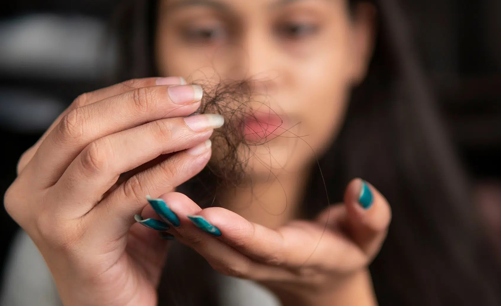 ریزش مو زنان - ریزش مو ناشی از سندرم تخمدان