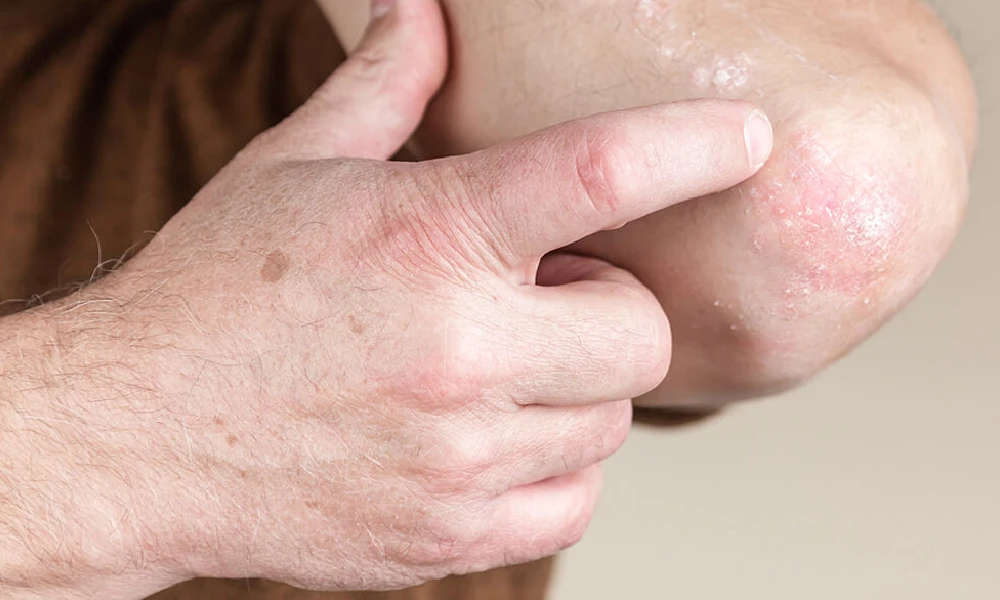 عفونت قارچی روی آرنج یک فرد