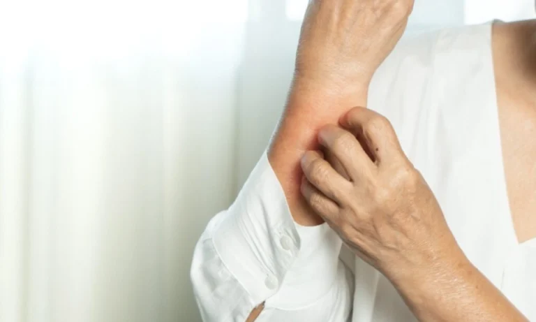 خارش پوستی | عفونت قارچی