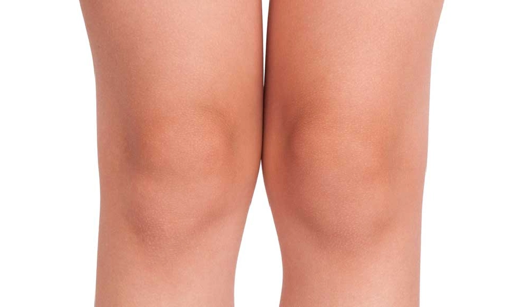 تیرگی زانو های پرانتری