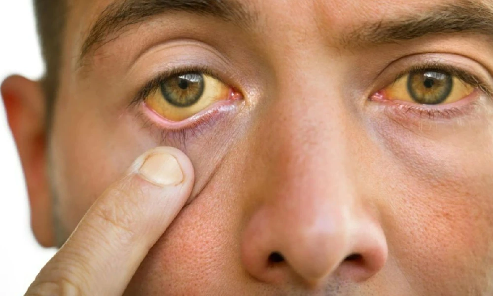 علائم کلسترول بالا نمایان شده در چشم های یک آقا